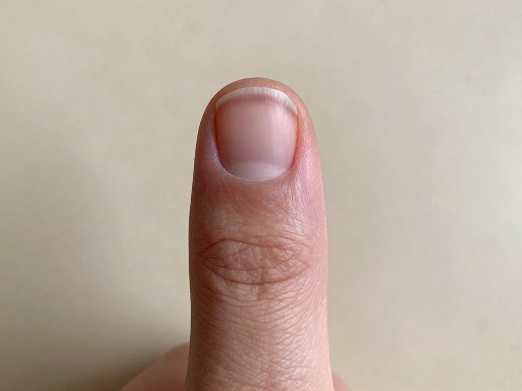 schwarze Stelle unter Fingernagel