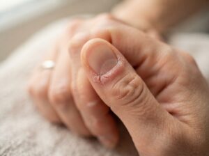 rissige Nagelhaut